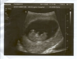 Ultrasound Scan: Determining the sex of a baby can also determine its fate. Photo by salimfadhley via Flickr.